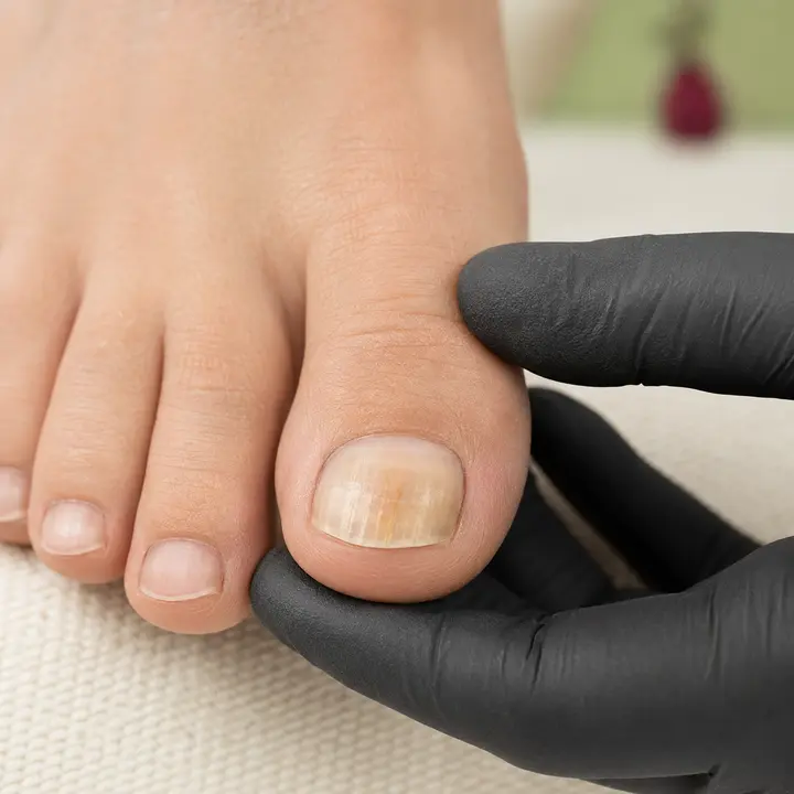 Nagelpilz – Beispielmotiv
