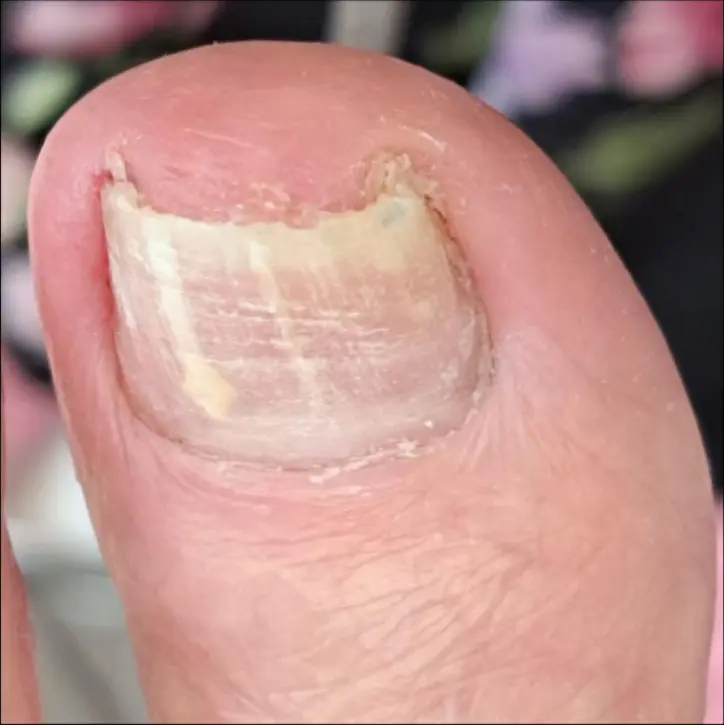 Nagelkorrektur mit Spange – Vorher, Vorher-Nachher-Vergleich