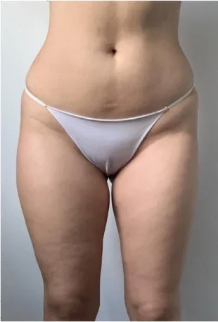 Volumen & Cellulite – Nachher