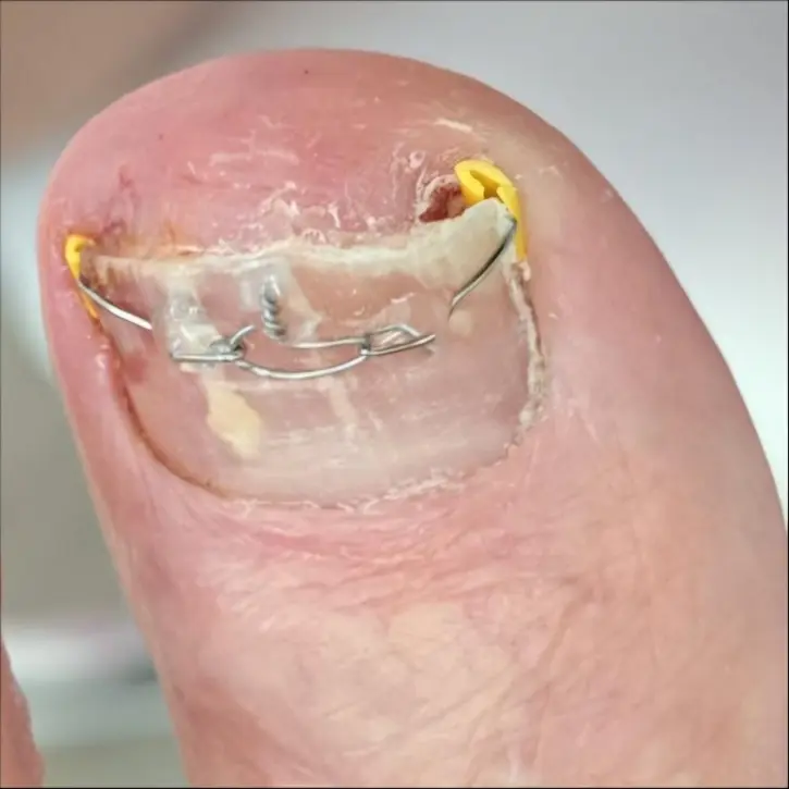 Nagelkorrektur mit Spange – Nachher, Vorher-Nachher-Vergleich